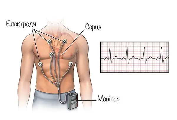 холтерівське моніторування