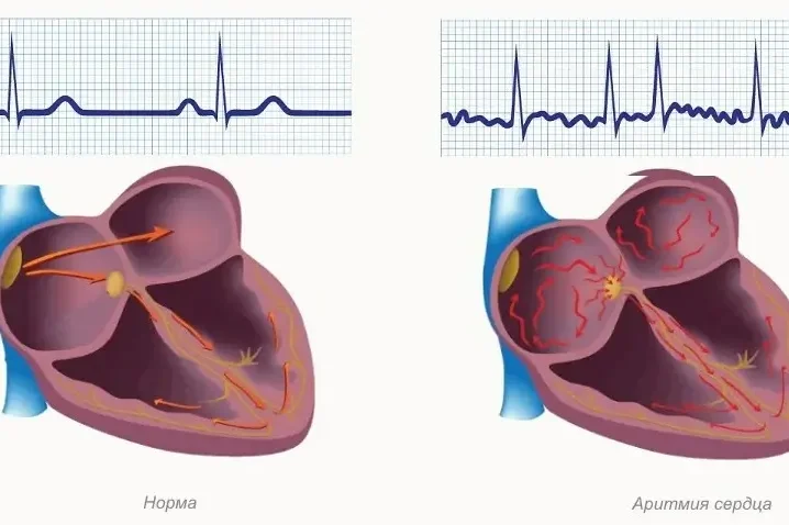 Аритмії — які бувають та як лікувати